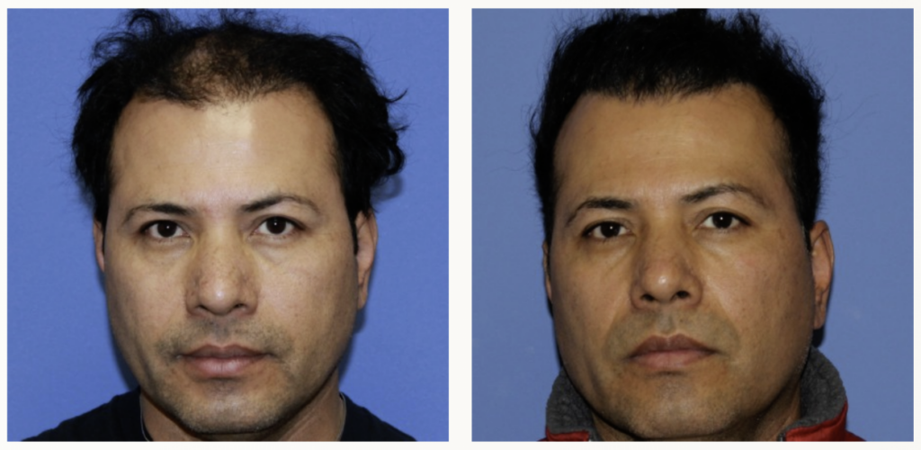 hair-surgery-explained-what-to-expect-before-during-after