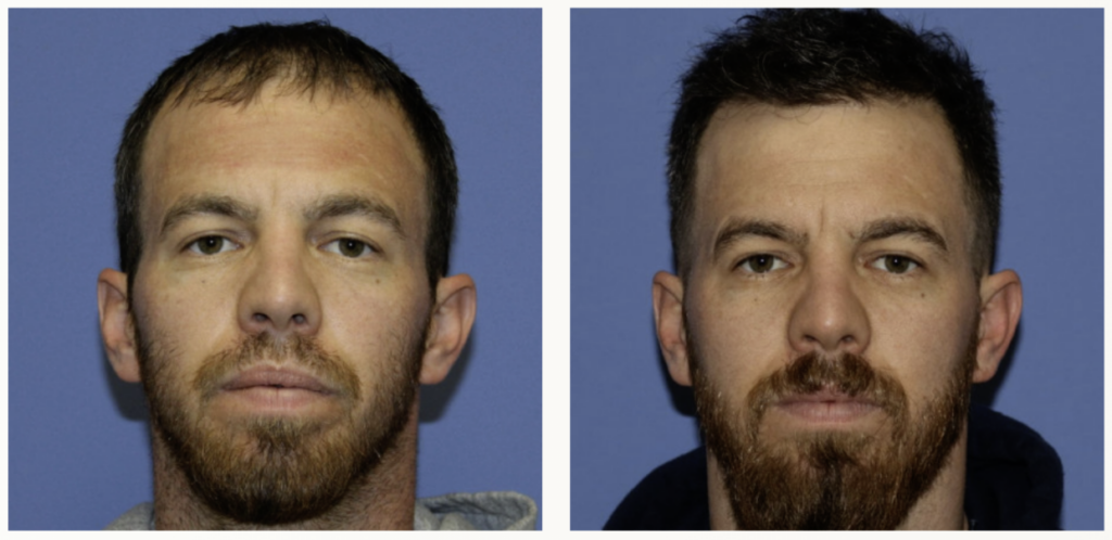 hair-transplant-utah-fue-vs-fut-and-which-one-fits-you