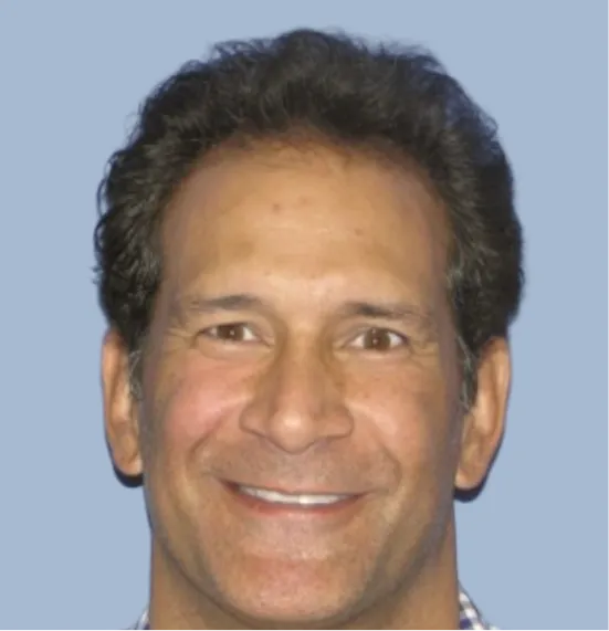 Before - Hair Restoration Patient 1