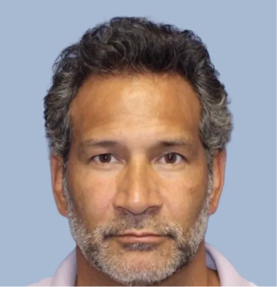 After - Hair Restoration Patient 1