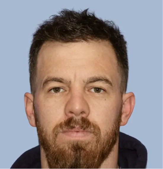 After - Hair Restoration Patient 2