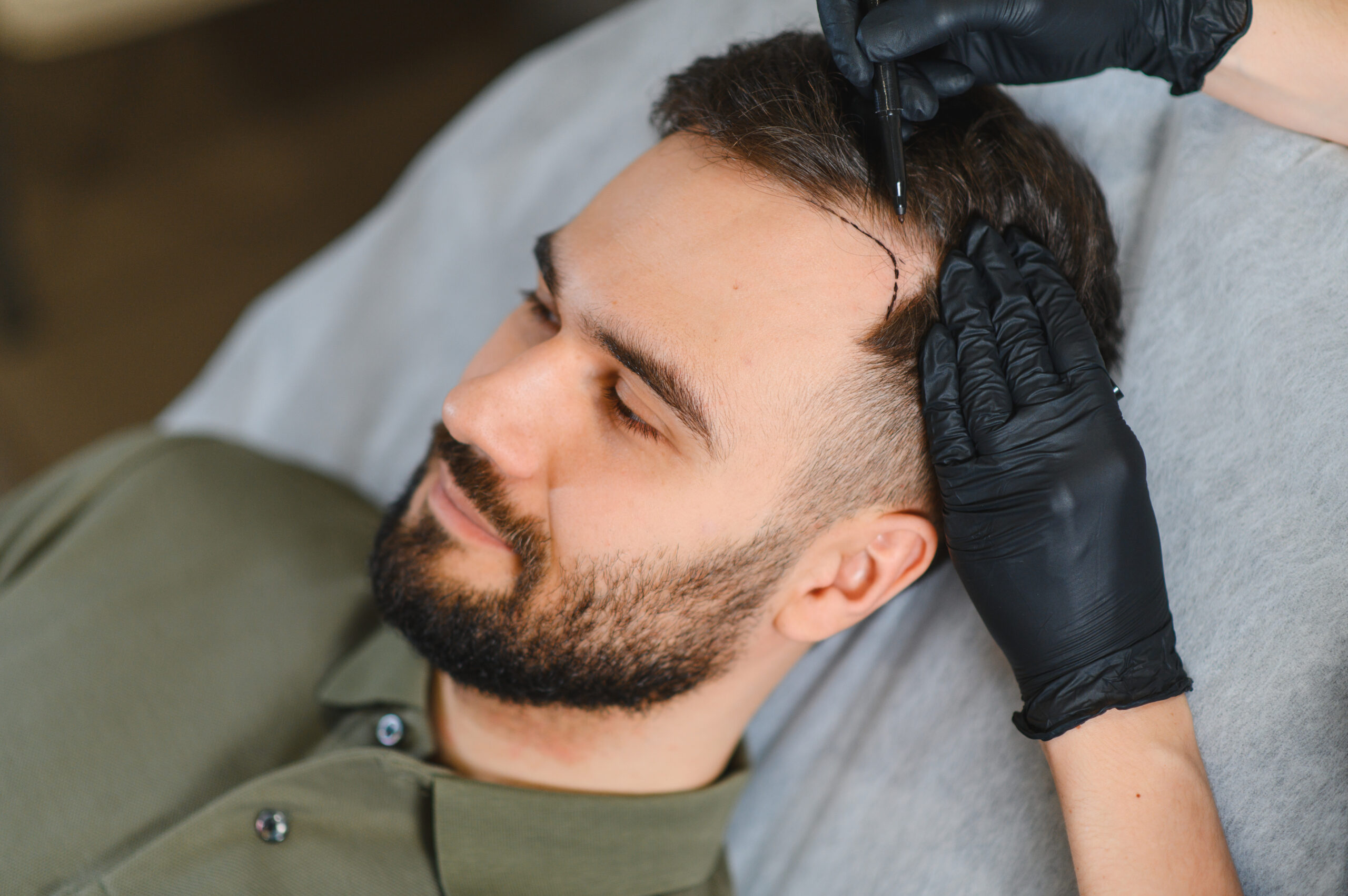 Dr. Bitner marking a natural hairline design on a male FUE hair transplant patient